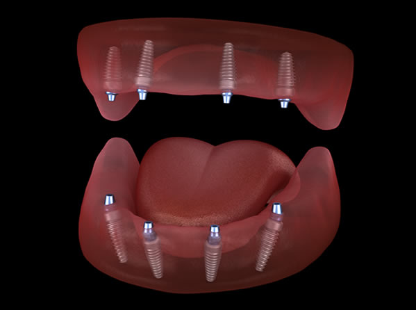 Full Arch Dental Implants