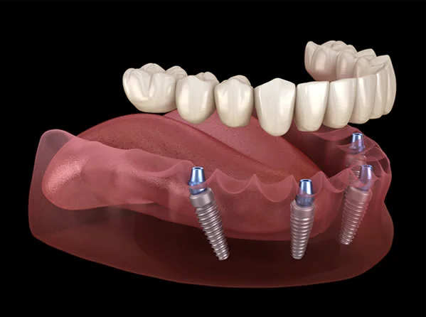 Can Restore Teeth Of Upper Or Lower Jaw