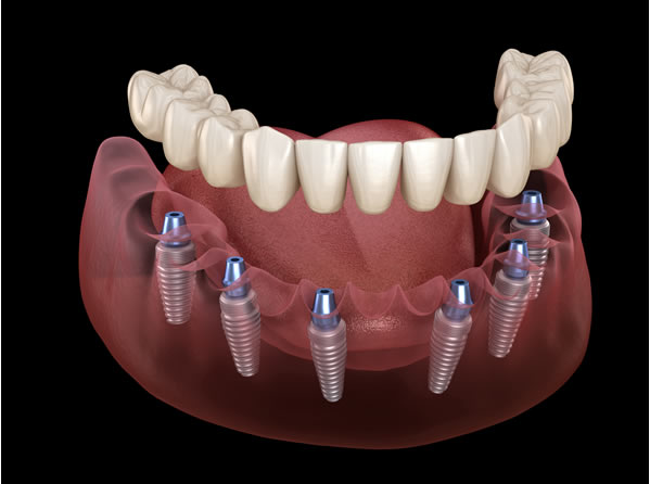 Restores A Full Arch Of Teeth