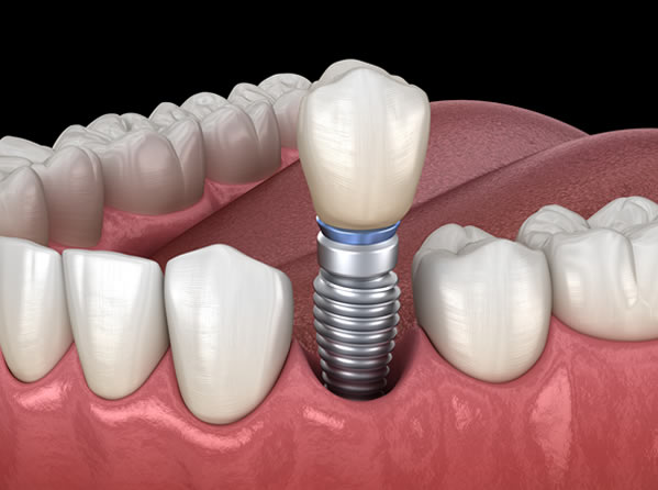 Single Tooth Replacement