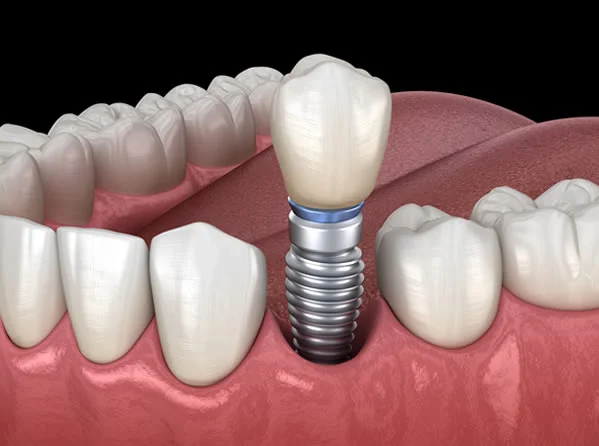 Single Tooth Replacement