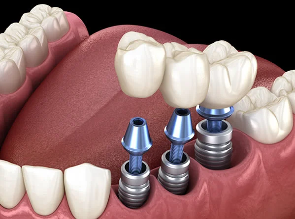 Multiple Tooth Replacement