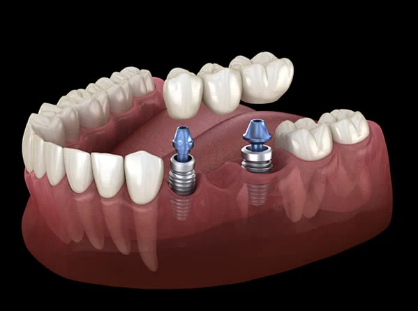 Implant Supported Dental Bridge