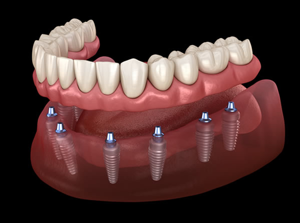 All-On Dental Implants