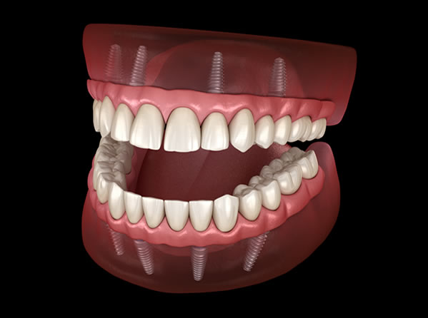 Full Mouth Restoration