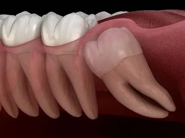 WISDOM TEETH IMPACTIONS IMG1