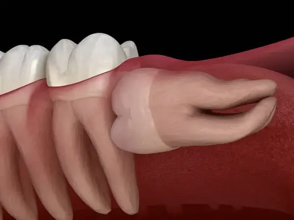 WISDOM TEETH IMPACTIONS IMG2