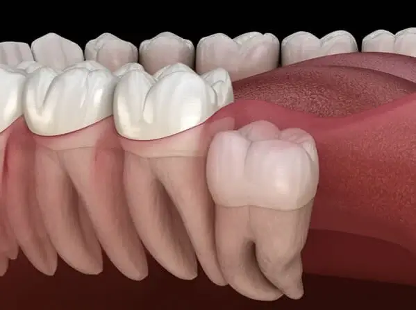 WISDOM TEETH IMPACTIONS IMG3